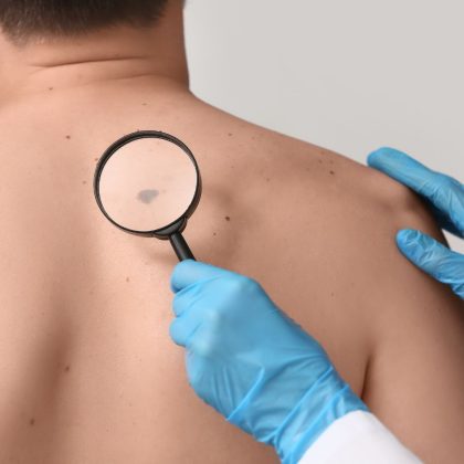 Dermatologist with Magnifying Glass Examining Moles of Young Man on White Background, Closeup